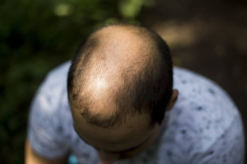 Androgenetic Alopecia & DHT 