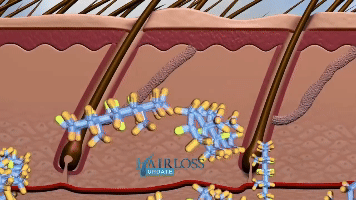 DHT minaturization of follicles