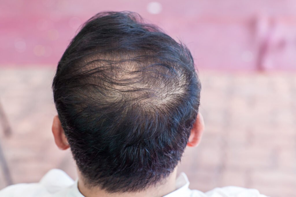 Hair Loss Myths Debunked