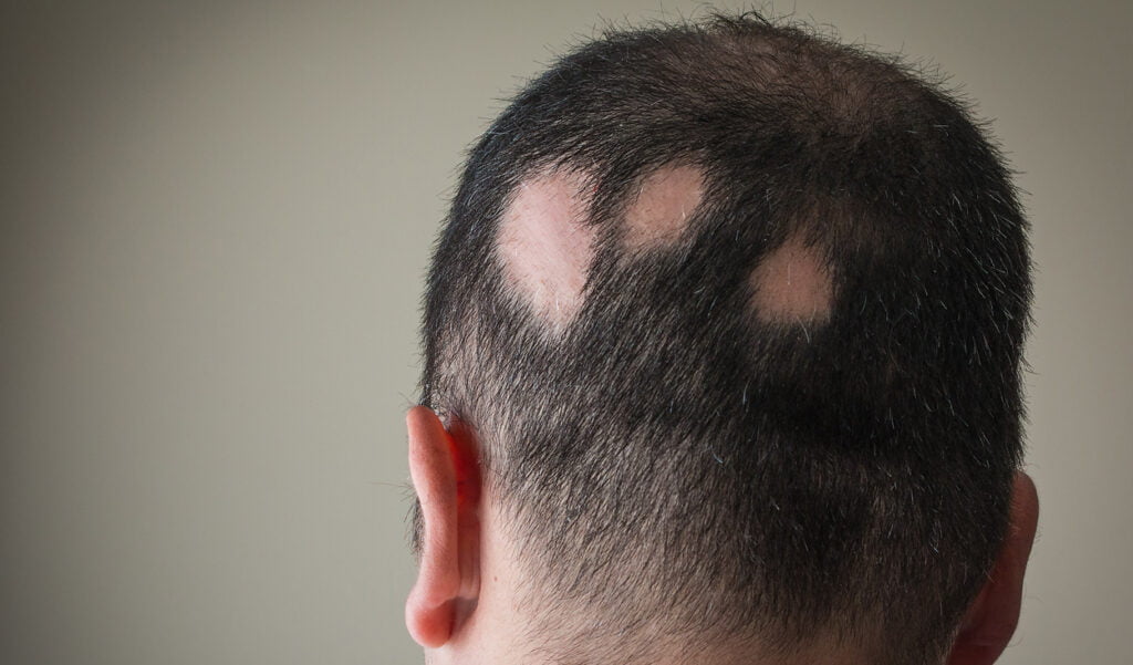 alopecia areata hair pattern