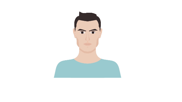 norwood Balding stages animated.gif