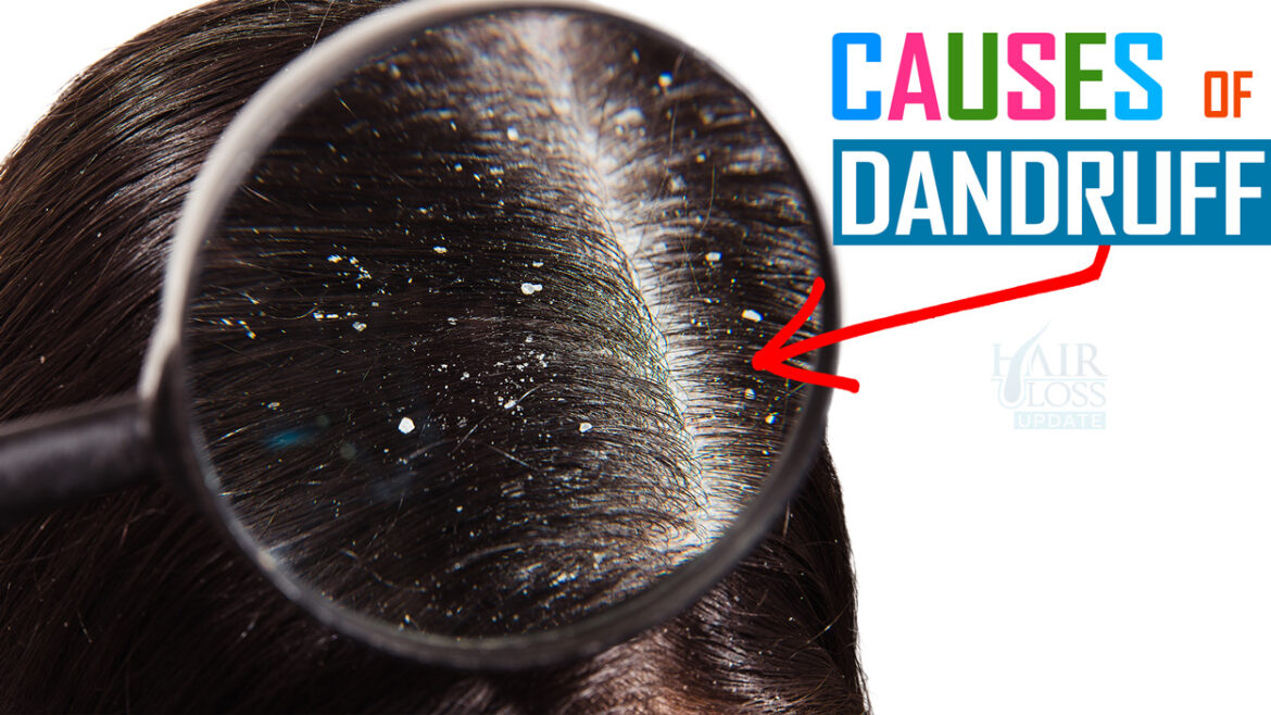 Understanding-Dandruff-and-Causes-of-Dandruff-Flakes Understanding Dandruff and Causes of Dandruff Flakes